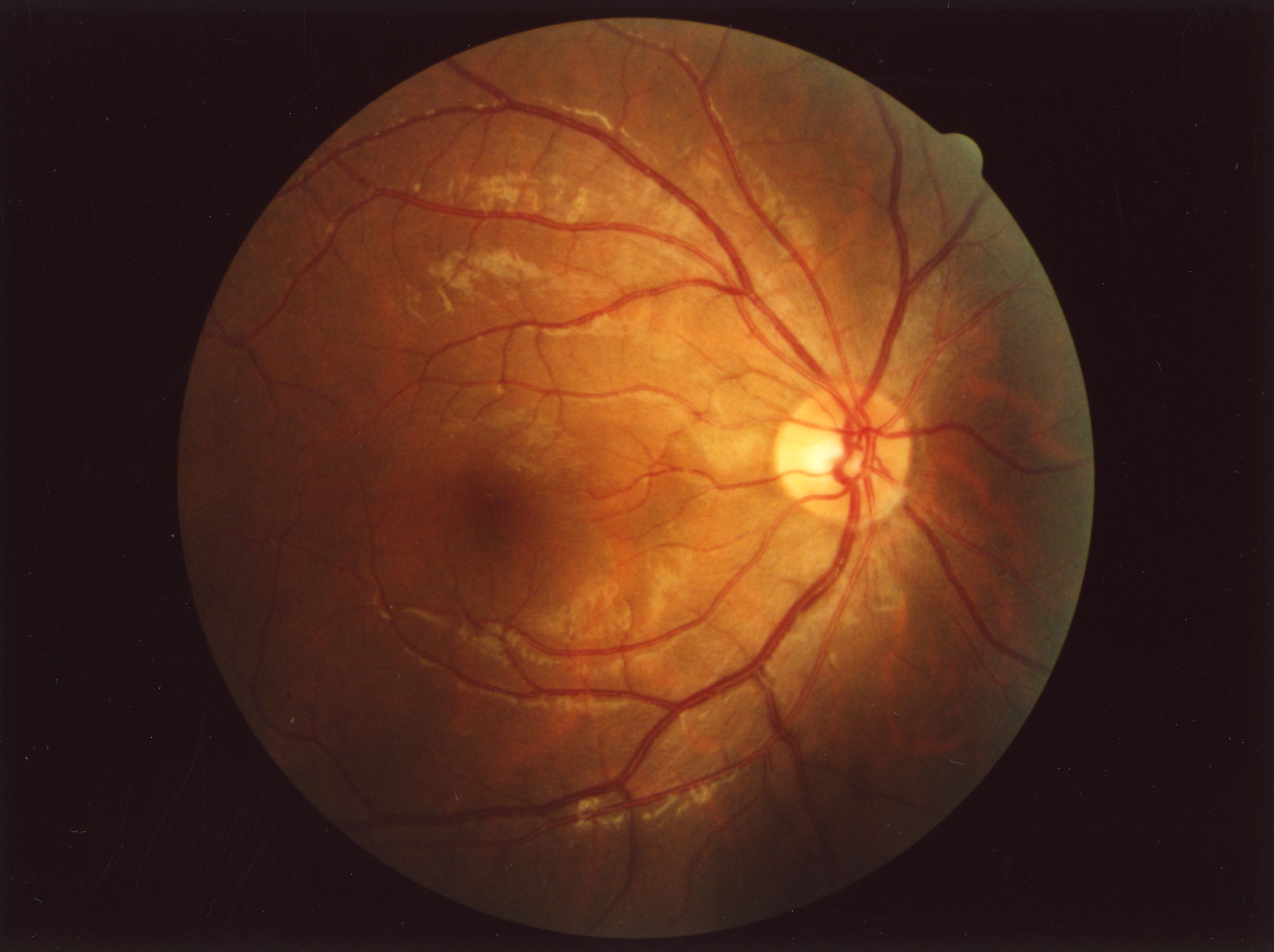 Fundus Examination